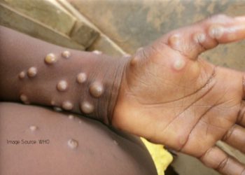 Monkeypox Disease: All You Need to Know