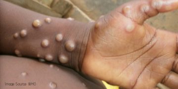 Monkeypox Disease: All You Need to Know