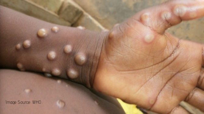 Monkeypox Disease: All You Need to Know