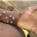 Monkeypox Disease: All You Need to Know