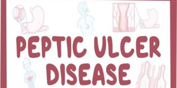 Peptic Ulcer Disease On The Rise In Jaman North – Nurse Reveals