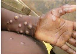 Ghana confirms two Mpox cases as GHS assures public of containment measures