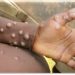 Ghana confirms two Mpox cases as GHS assures public of containment measures